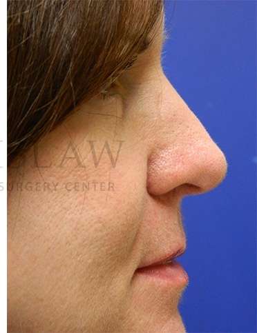 Rhinoplasty Before & After Patient #1263