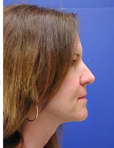 Rhinoplasty Before & After Patient #1263