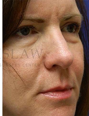 Rhinoplasty Before & After Patient #1263