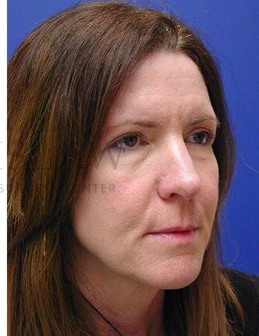 Rhinoplasty Before & After Patient #1263