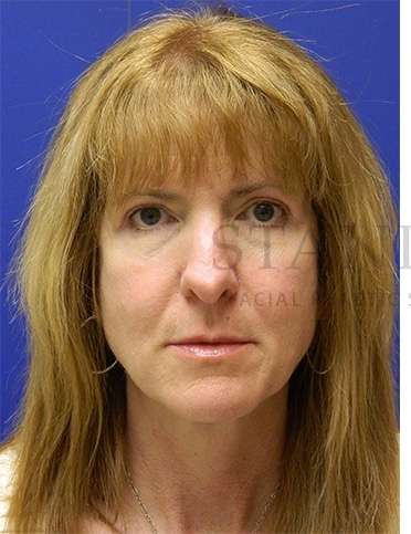 Rhinoplasty Before & After Patient #1263