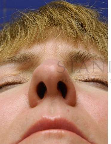 Rhinoplasty Before & After Patient #1263