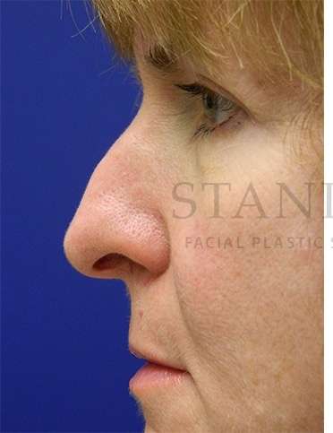 Rhinoplasty Before & After Patient #1263