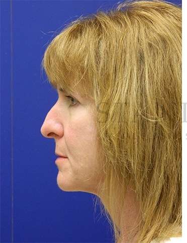Rhinoplasty Before & After Patient #1263