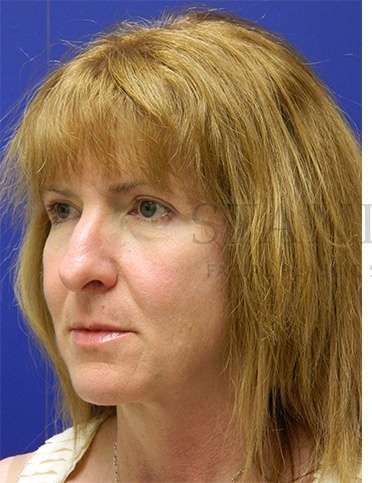 Rhinoplasty Before & After Patient #1263
