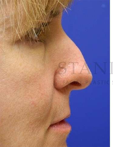 Rhinoplasty Before & After Patient #1263