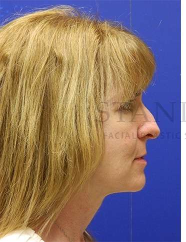 Rhinoplasty Before & After Patient #1263