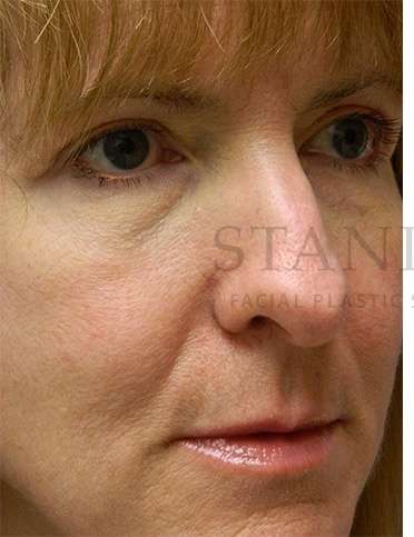 Rhinoplasty Before & After Patient #1263