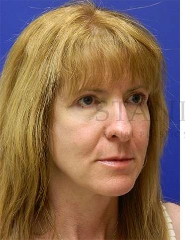 Rhinoplasty Before & After Patient #1263