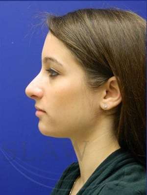 Rhinoplasty Before & After Patient #1244