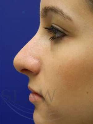 Rhinoplasty Before & After Patient #1244
