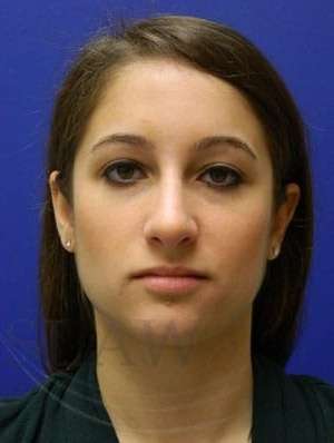 Rhinoplasty Before & After Patient #1244
