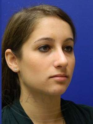 Rhinoplasty Before & After Patient #1244