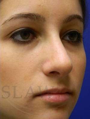 Rhinoplasty Before & After Patient #1244