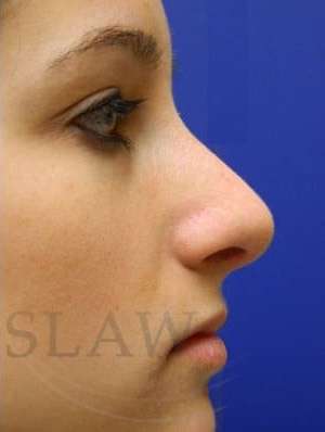 Rhinoplasty Before & After Patient #1244