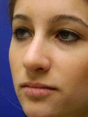 Rhinoplasty Before & After Patient #1244