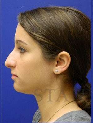 Rhinoplasty Before & After Patient #1244