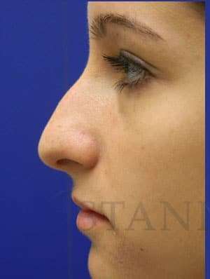 Rhinoplasty Before & After Patient #1244