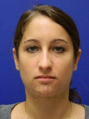 Rhinoplasty Before & After Patient #1244