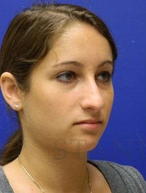 Rhinoplasty Before & After Patient #1244