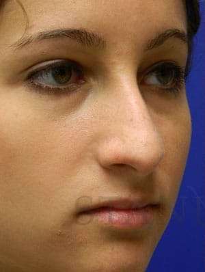 Rhinoplasty Before & After Patient #1244