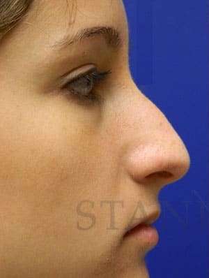 Rhinoplasty Before & After Patient #1244