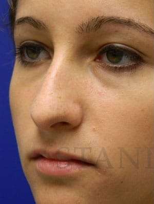 Rhinoplasty Before & After Patient #1244