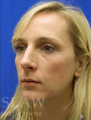 Rhinoplasty Before & After Patient #1229