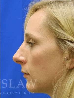 Rhinoplasty Before & After Patient #1229