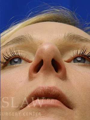 Rhinoplasty Before & After Patient #1229