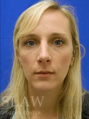 Rhinoplasty Before & After Patient #1229