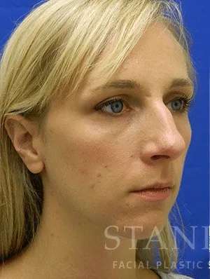 Rhinoplasty Before & After Patient #1229