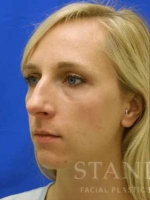 Rhinoplasty Before & After Patient #1229