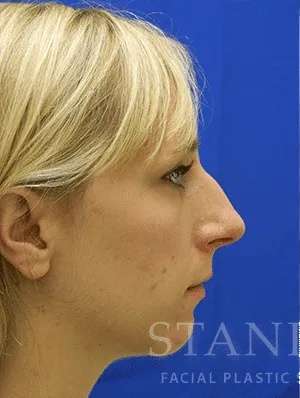 Rhinoplasty Before & After Patient #1229