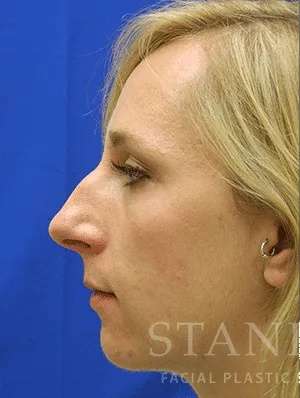 Rhinoplasty Before & After Patient #1229