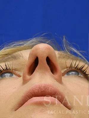 Rhinoplasty Before & After Patient #1229