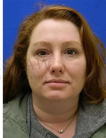 Rhinoplasty Before & After Patient #1216