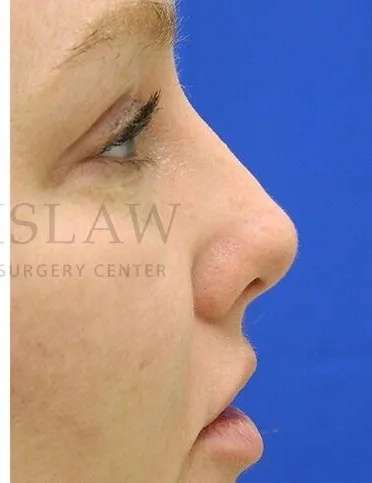 Rhinoplasty Before & After Patient #1216