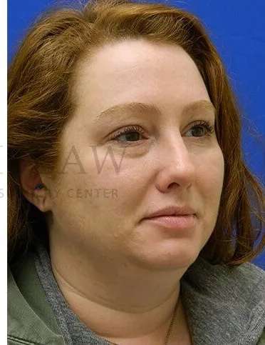 Rhinoplasty Before & After Patient #1216