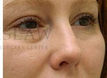Rhinoplasty Before & After Patient #1216