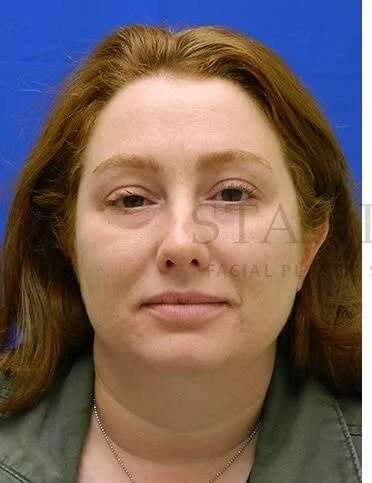 Rhinoplasty Before & After Patient #1216