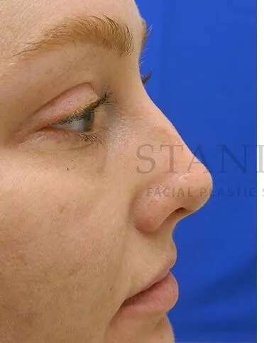 Rhinoplasty Before & After Patient #1216