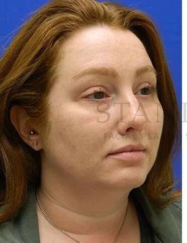 Rhinoplasty Before & After Patient #1216