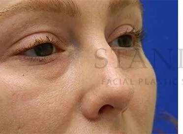 Rhinoplasty Before & After Patient #1216