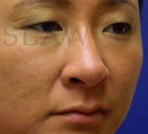 Rhinoplasty Before & After Patient #1207
