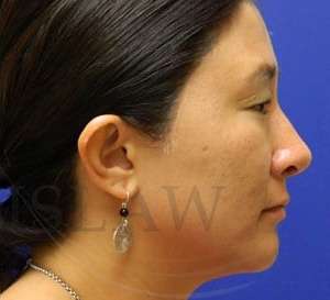 Rhinoplasty Before & After Patient #1207