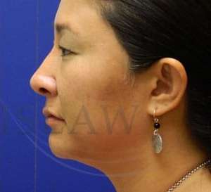 Rhinoplasty Before & After Patient #1207