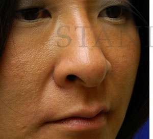 Rhinoplasty Before & After Patient #1207