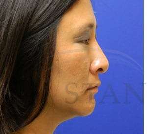 Rhinoplasty Before & After Patient #1207
