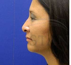 Rhinoplasty Before & After Patient #1207